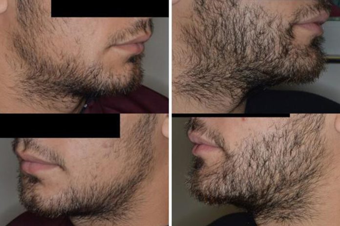 Beard Transplant Dubai