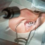 lasik surgery cost