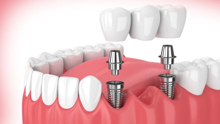Discover Excellence in Dental Implants with Dr. Sunny Badyal Discover Excellence in Dental Implants with Dr. Sunny Badyal