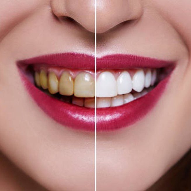 teeth whitening grande prairie cobblestone dental