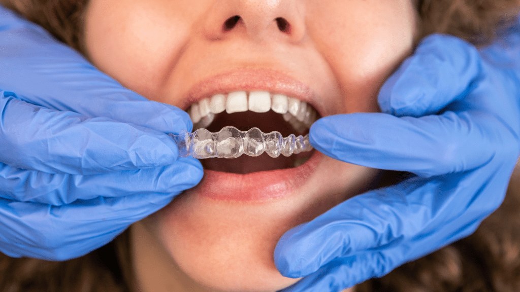 Clearline Aligners: A Comfortable Way to Fix Your Smile in Downtown Vancouver clearline aligners downtown vancouver