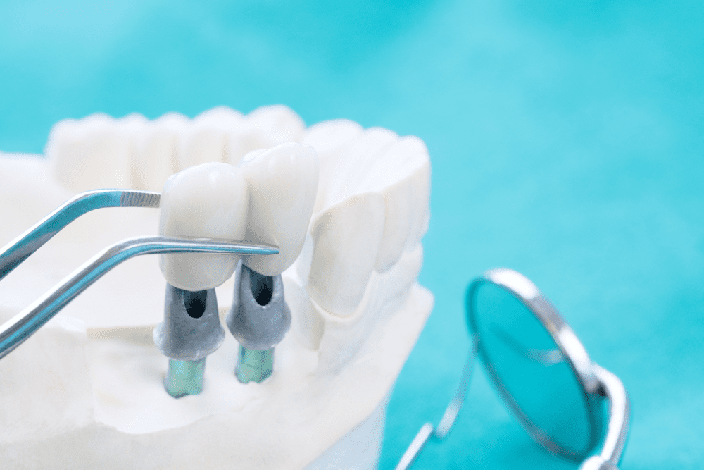 How Dental Bridges Can Prevent Shifting Teeth How Dental Bridges Can Prevent Shifting Teeth