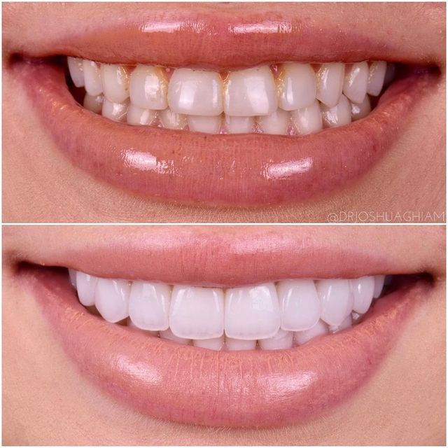 Dental Implants in Sacramento: A Complete Guide to Restoring Your Smile Dental Implants in Sacramento: A Complete Guide to Restoring Your Smile
