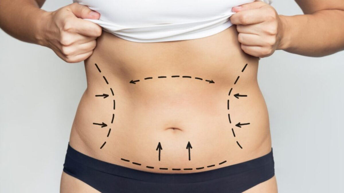 Confident Looks After Liposuction Surgery in Dubai Ultimate Style Confident Looks After Liposuction Surgery in Dubai Ultimate Style