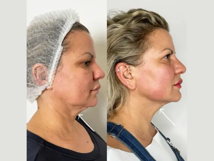 My Transformation Journey with Endolift at the Best Aesthetic Clinic in Dubai Endolift Doctors in Dubai
