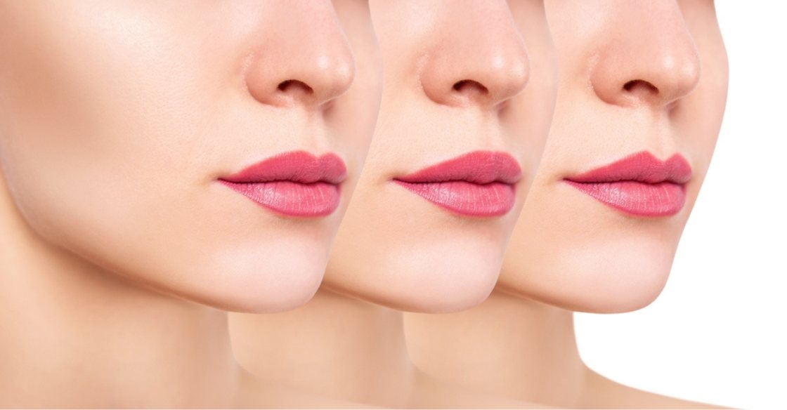 Lip Fillers That Look Like You – Only Better Lip Fillers