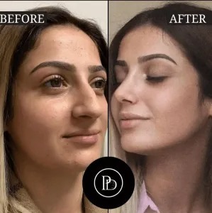Best Plastic Surgeon in Dubai for Botox and Dermal Fillers
