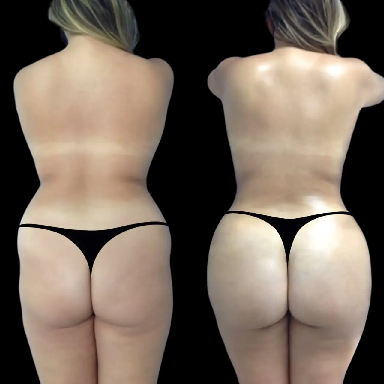 Hyacorp Fillers Treatment in Dubai: Perfect Choice for Men and Women Hyacorp Fillers in dubai