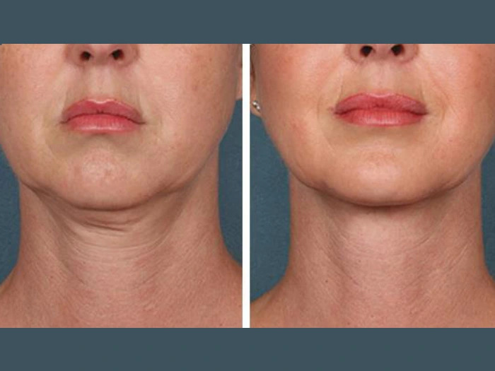 PRP Treatment in Dubai for Healthy Hair Growth Prp Treatment in dubai