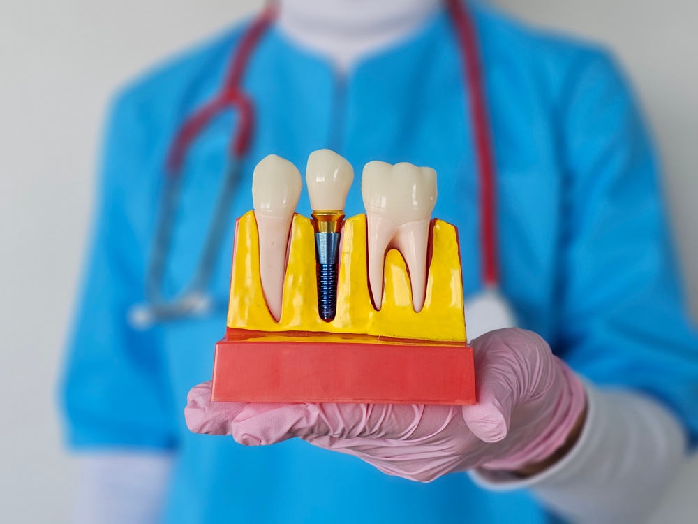 Dental Implants and Dental Crowns: A Complete Guide to Tooth Replacement and Restoration Dental Implants and Dental Crowns: A Complete Guide to Tooth Replacement and Restoration