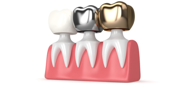 Temporary vs. Permanent Crowns: What Patients Should Know what makes composite ceramic and metal fillings different