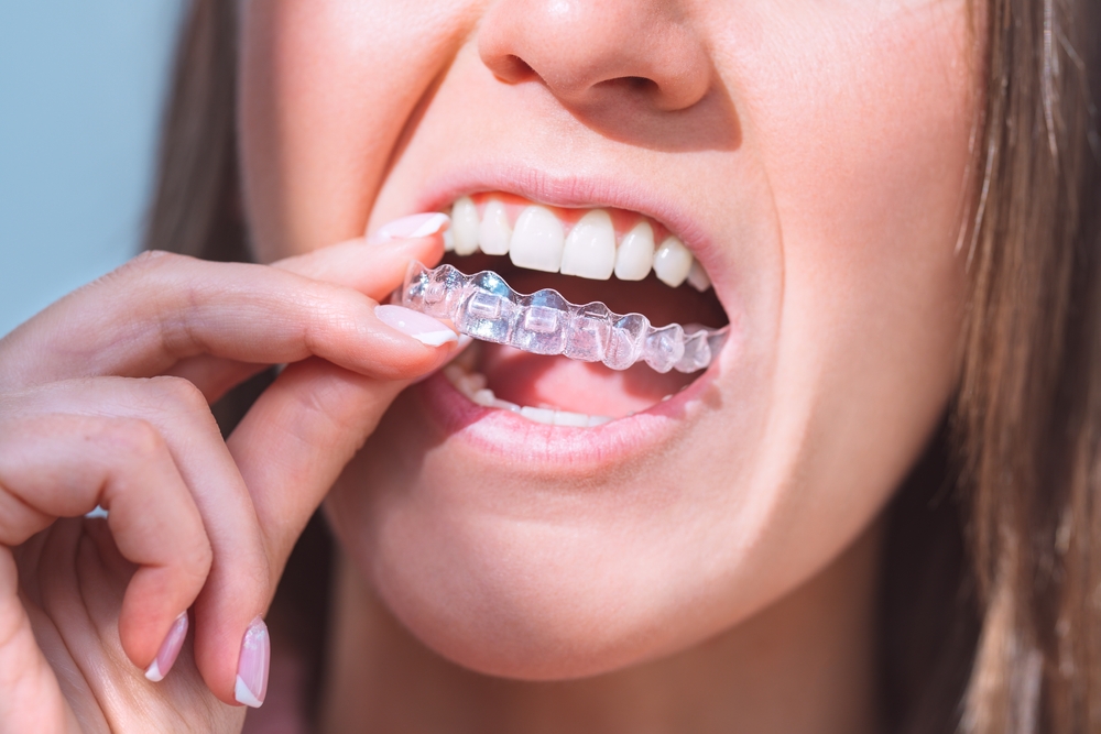 Invisalign for Teens vs. Adults: Key Differences & Benefits Invisalign for Teens vs. Adults: Key Differences & Benefits