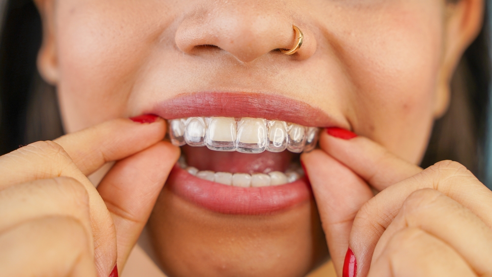 Straighten Your Smile with Invisalign – Burnaby Orthodontic Guide straighten your smile with invisalign burnaby orthodontic guide