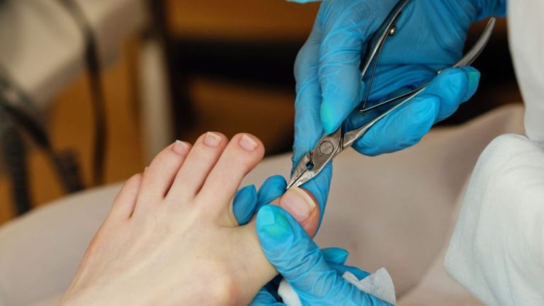 Are Antibiotics Enough or Is Ingrown Toenail Removal Necessary for Recurrent Infections