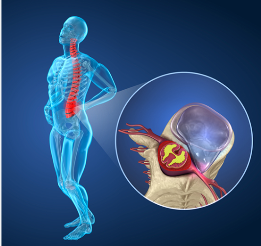A Simple Guide to Treating Lumbar Radiculopathy A Simple Guide to Treating Lumbar Radiculopathy