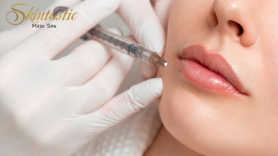 Best Lip Fillers Riverside for Natural Volume Lip Fillers Riverside