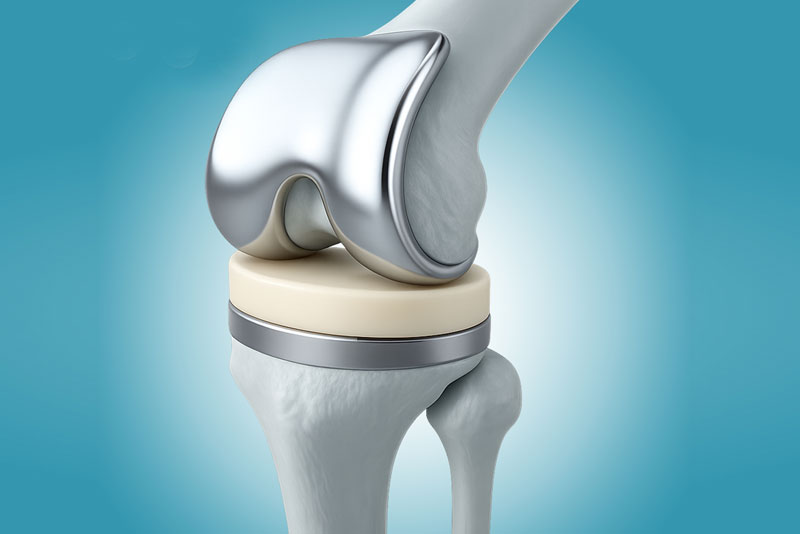 Knee replacement