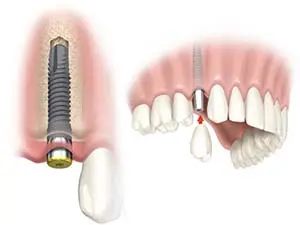 How Dental Implants Restore Oral Health Dental Implants Vienna Va