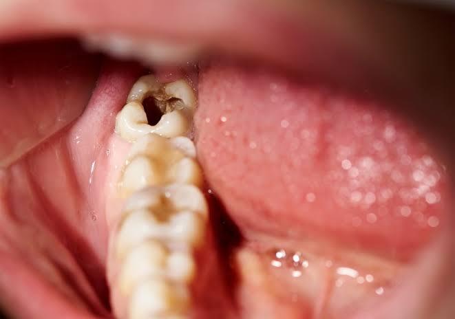 What Are the Most Common Oral Health Problems in Pakistan? Oral Health Problems
